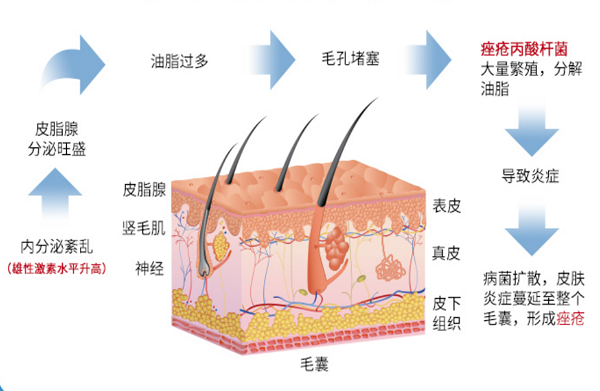 生命不息，“战痘”不止，脸上长痘用夫西地酸乳膏多久见效