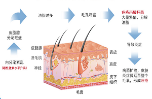 痘痘反复长不停：身上有炎症反复长痘痘怎么办