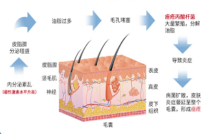 男性嚴(yán)重痤瘡是由什么引起的？這個(gè)原因很重要