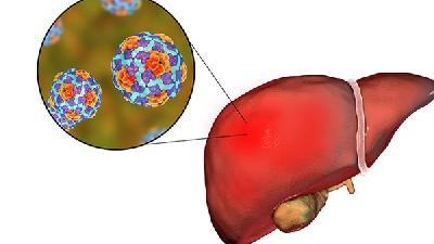 丙肝治疗时间需要多久？3种关于丙肝的知识点