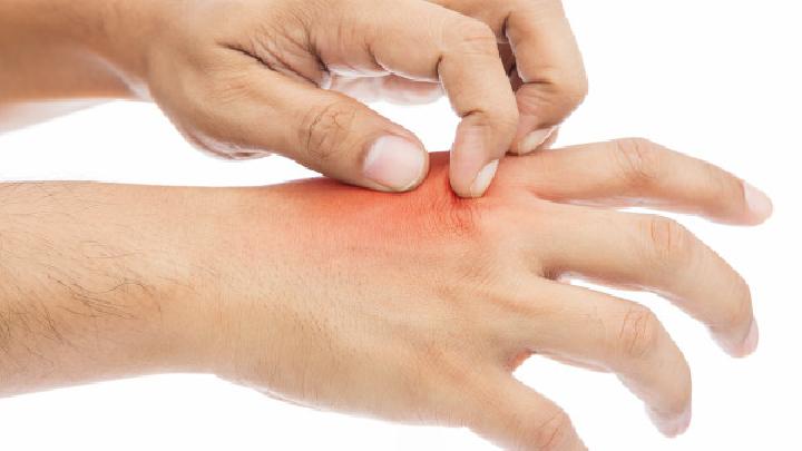 手癣怎么治疗才能除根？手癣的症状图片你看过吗？