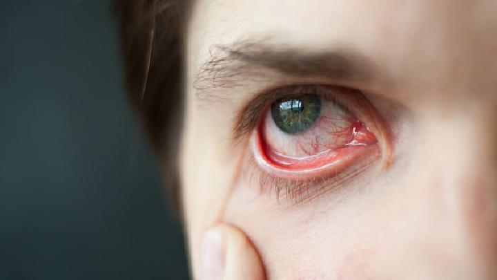 角膜炎用什么眼药水比较好？适合角膜炎使用的4款眼药水