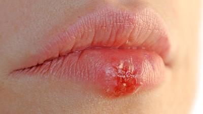 女性生殖器皰疹要怎么辦？女性治療生殖器皰疹注意四點(diǎn)