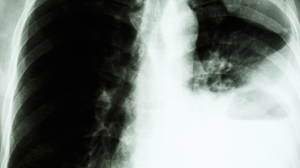 怎样预防肺癌骨转移 肺癌骨转移后的治疗方法