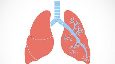 肺癌的相应早期症状有哪些 肺癌早期主要有5个症状表现