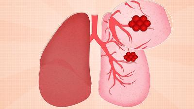 肺癌诊断的要点有哪些 诊断肺癌把握三大要点