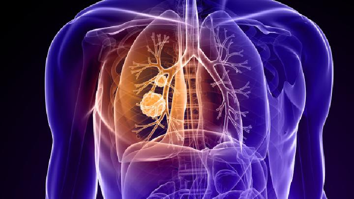 不同类型的肺癌怎么治疗五类型肺癌的具体治疗措施介绍
