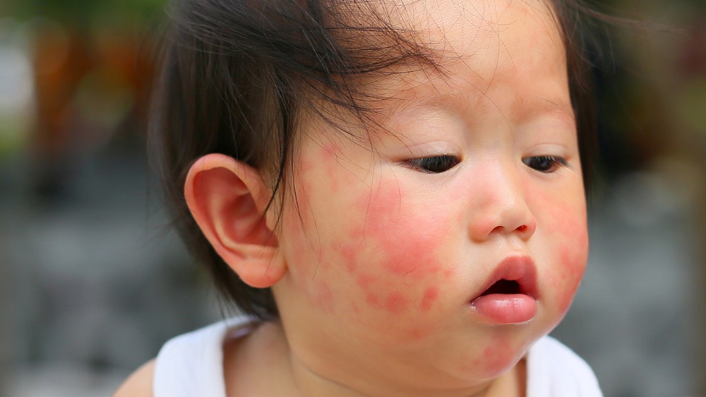 嬰兒長濕疹是什么原因？嬰兒起濕疹如何治療？怎么護理？