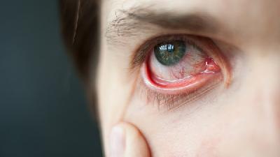 真菌性角膜炎是怎么引发的？预防角膜炎警惕这4件事