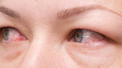 抗病毒眼药水能治病毒性眼角膜炎吗？预防病毒角膜炎怎么做