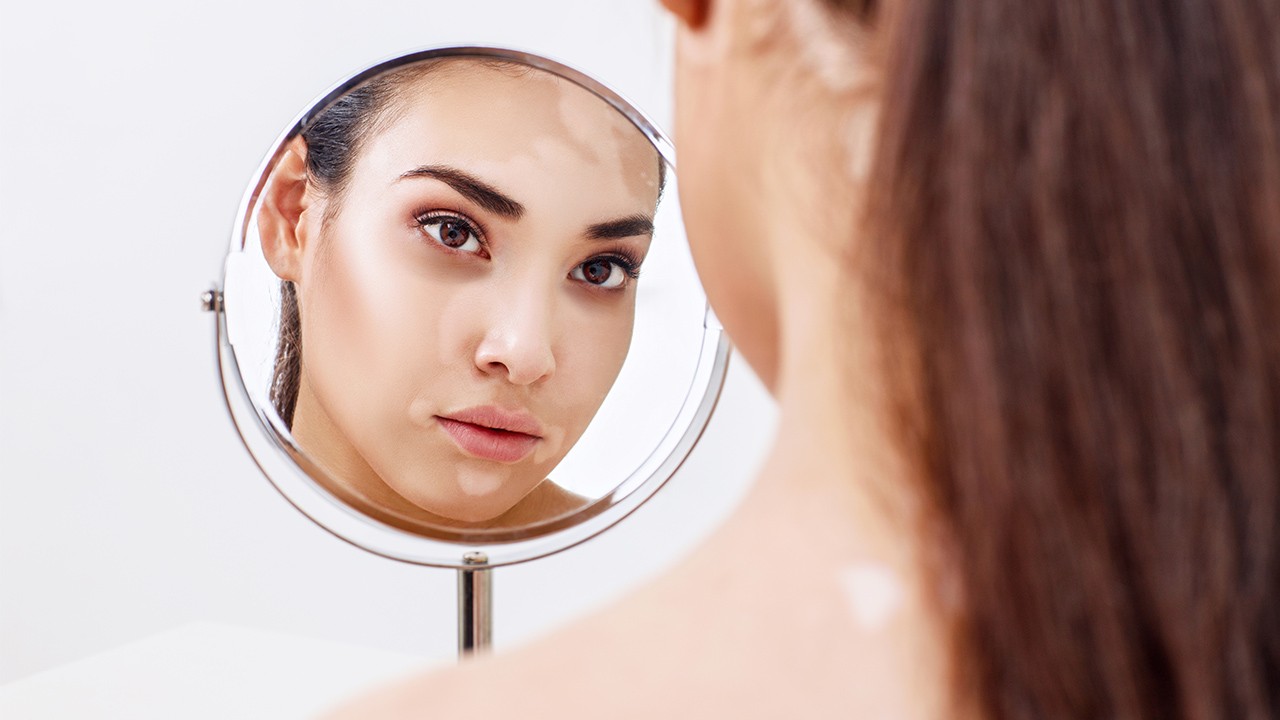 白癜风孕妇不能吃那些药