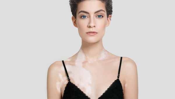 白癜风吃什么药好得快