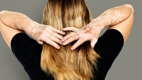 治疗白癜风如何用药