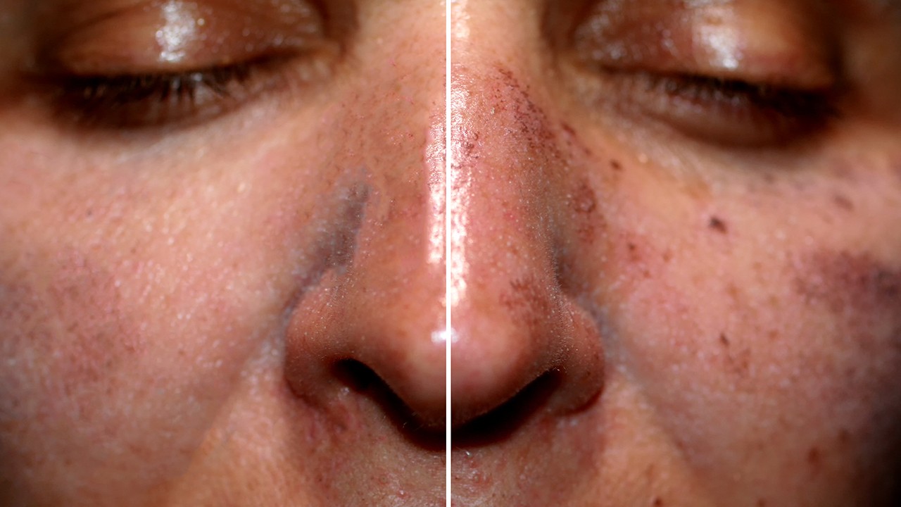 黄褐斑 喝中药调理