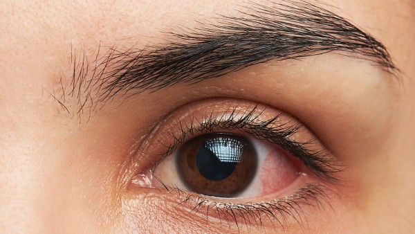 干眼、红眼，抗生素眼药水并非首选，中医：桑叶3用法效果尚佳