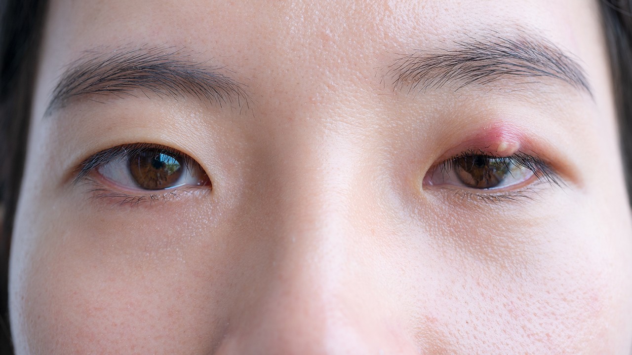 霰粒肿吃什么药效果最好