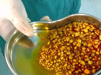 充盈性胆结石一定要切除胆囊吗