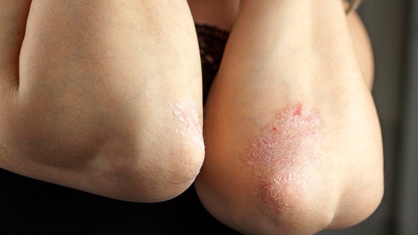 寻常型银屑病中医用药方法