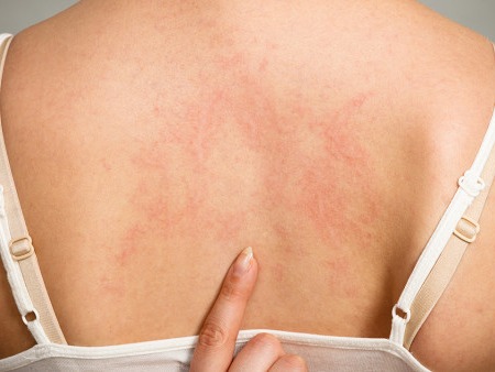 现在是荨麻疹的高发季节吗？有什么需要注意的吗？