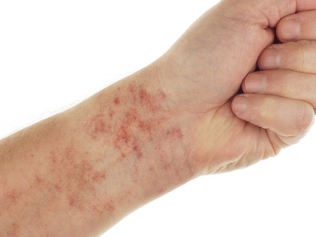 现在是荨麻疹的高发季节吗？有什么需要注意的吗？
