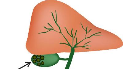 脂肪肝症状严重程度怎么区分 脂肪肝症状程度的区分法