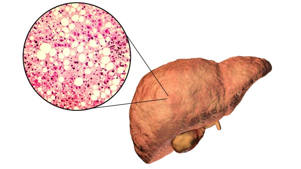 脂肪肝的预防方法有哪些 脂肪肝的危害和预防方法