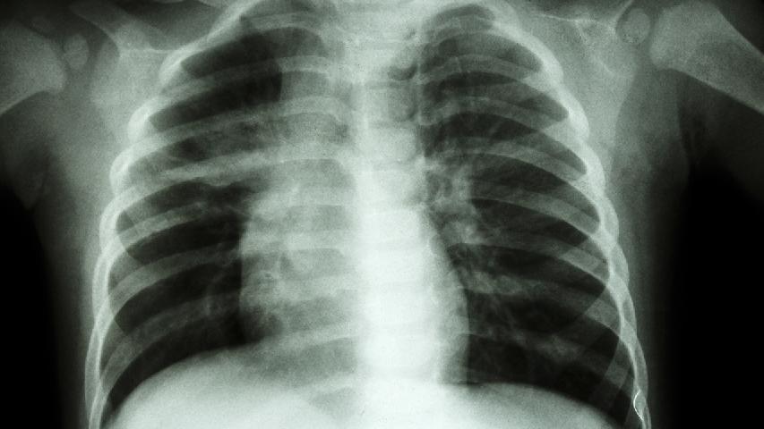 肺癌早期应做什么检查 重视肺癌早期的5个检查项目
