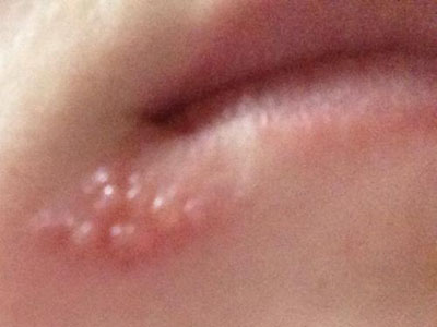 嘴边起泡泡的时候一定要注意这些 薄荷健康网