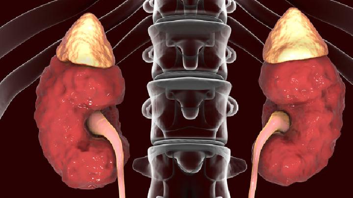 肾积水不能吃什么食物肾积水的5个饮食禁忌须知