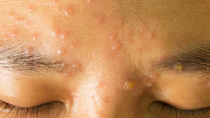 左下巴长痘痘的原因是什么？如何去除脸上的痘痘？
