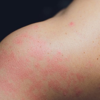 湿疹都有哪些症状？又该如何治疗呢？
