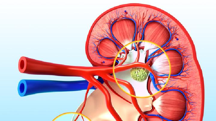 慢性腎炎有什么癥狀表現(xiàn)慢性腎炎的病因有四種