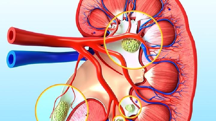 男性腎結(jié)石怎樣治最好男性腎結(jié)石最有效治療方法大全