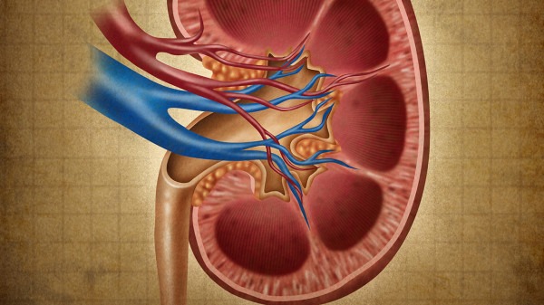 左腎結石可以治嗎 左腎結石飲食把握五項原則