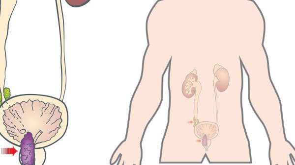 左腎結(jié)石可以治嗎 左腎結(jié)石飲食把握五項原則