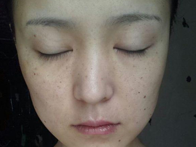 黄褐斑怎么去除女人去除色斑得注意这些