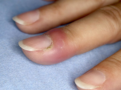 手指甲甲沟炎症状图片图片
