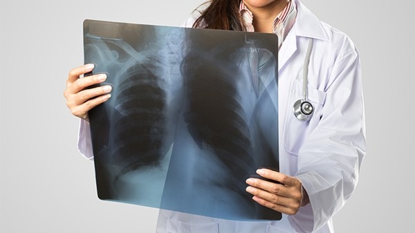 支气管肺癌怎么治疗好 揭秘支气管肺癌的常用治疗方案
