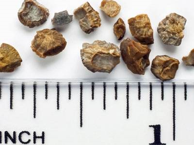 输尿管结石的症状表现介绍