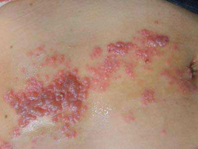 上海子宫癌治疗哪家医院效果好 39健康问答_郑州治疗