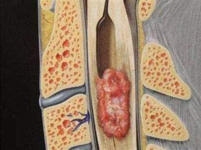 【医学科普】脊髓空洞症你了解多少?