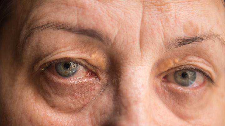 滴眼液能治单纯疱疹性角膜炎吗单纯疱疹性角膜炎怎么应对？