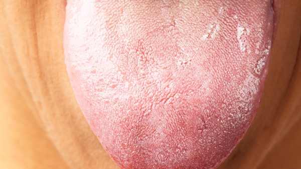 舌根部有黄腻的舌苔怎样治疗  小柴胡颗粒舌苔黄腻可以吃吗