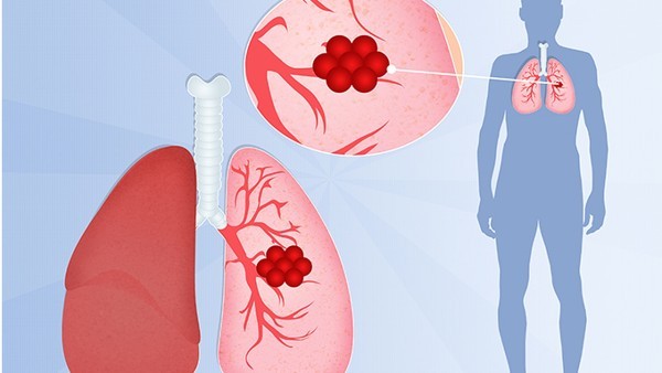治疗新冠肺炎有哪些中成药 三力藿香正气胶囊能和金花清感颗粒一起吃吗