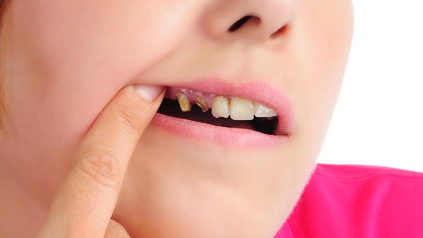 牙周炎应该怎样治疗？牙周炎形成的原因是什么？