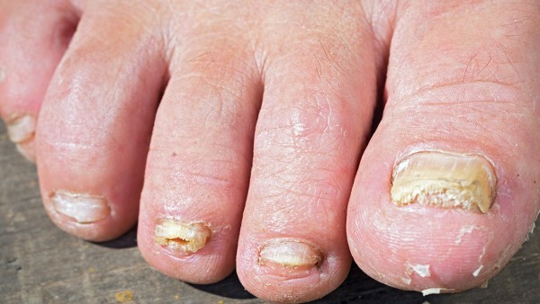 灰指甲和淤血的区别 灰指甲的表现有哪些