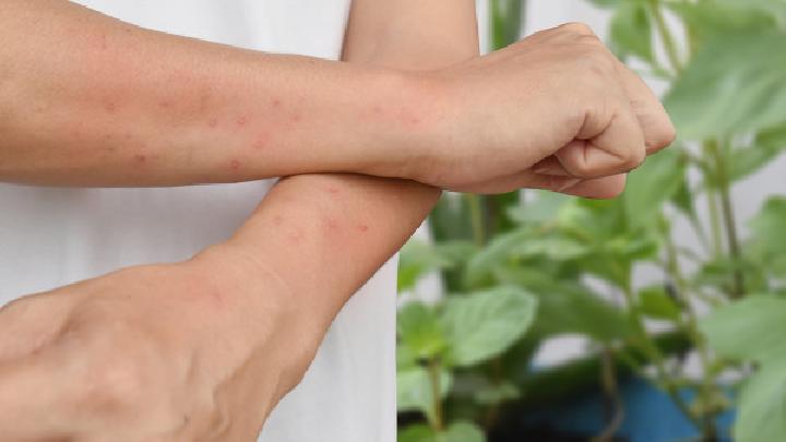 单纯痒疹的治疗原则是什么单纯痒疹的症状有哪些