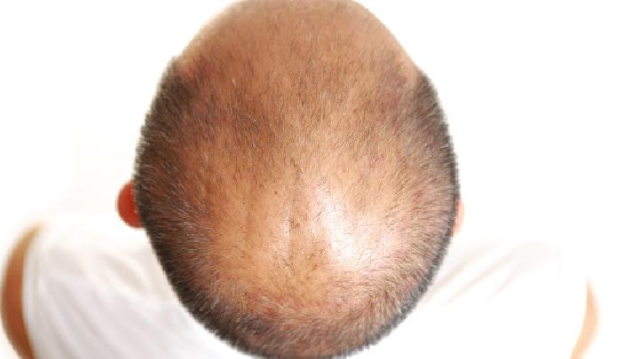 秃顶真的会遗传吗导致秃顶的原因是什么
