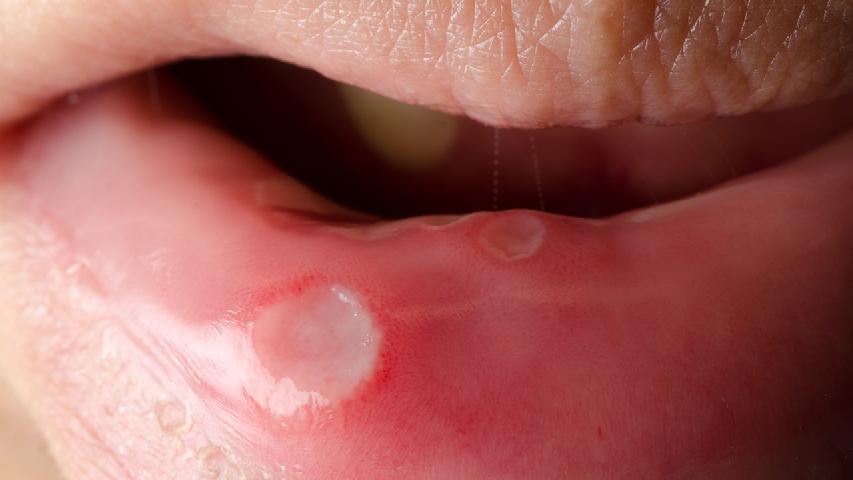 口腔溃疡可以用中药煲水喝吗 一次性长很多口腔溃疡严重吗？