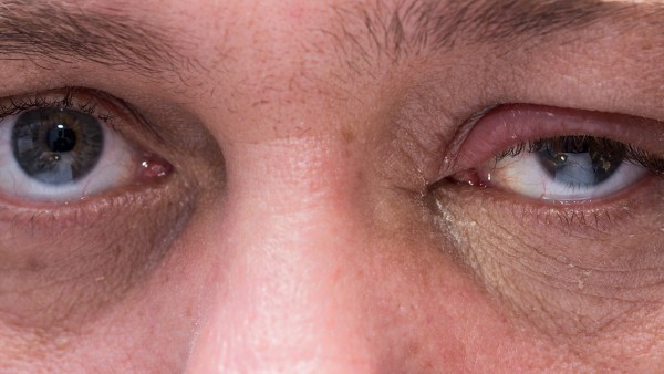 眼结石怎么治疗最好最快 治疗眼结石的特效药有哪些
